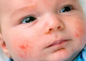 Bebés con alteraciones en la piel